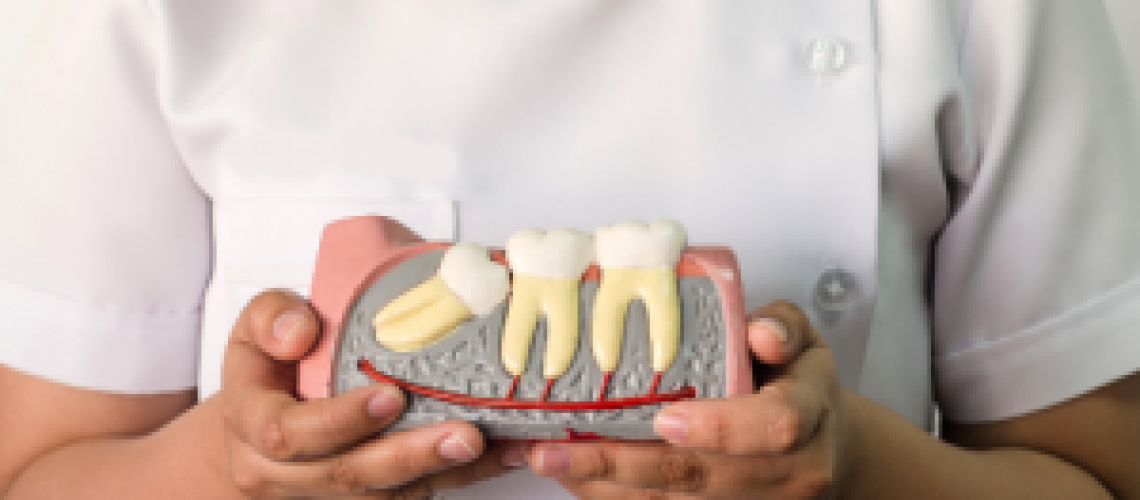 HowAreWisdomTeeth-300x240