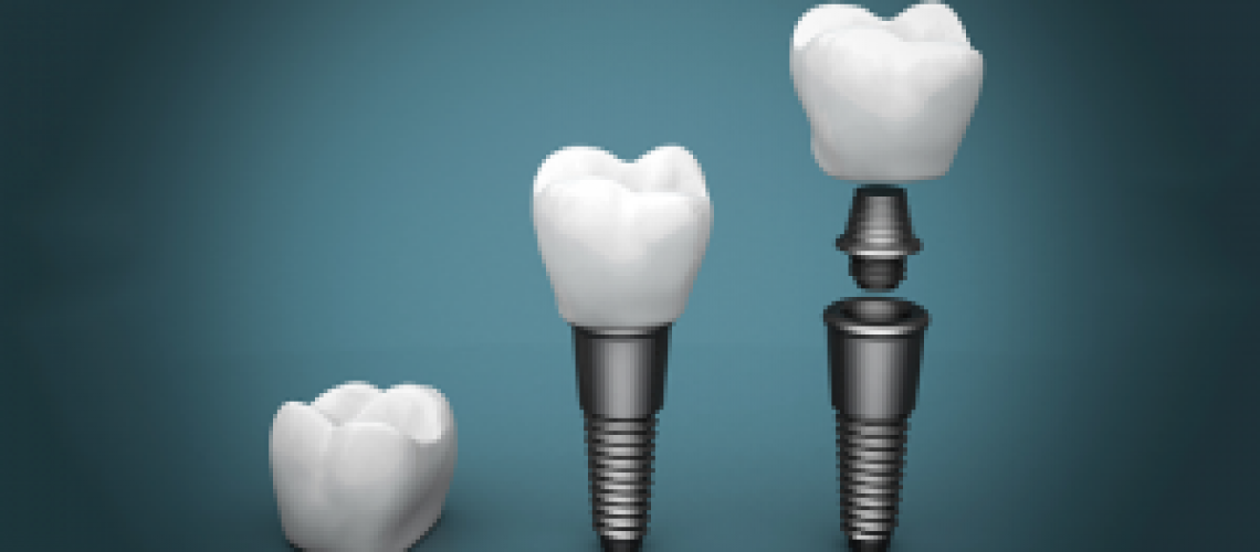 New-Trends-in-Dental-Implants-300x150