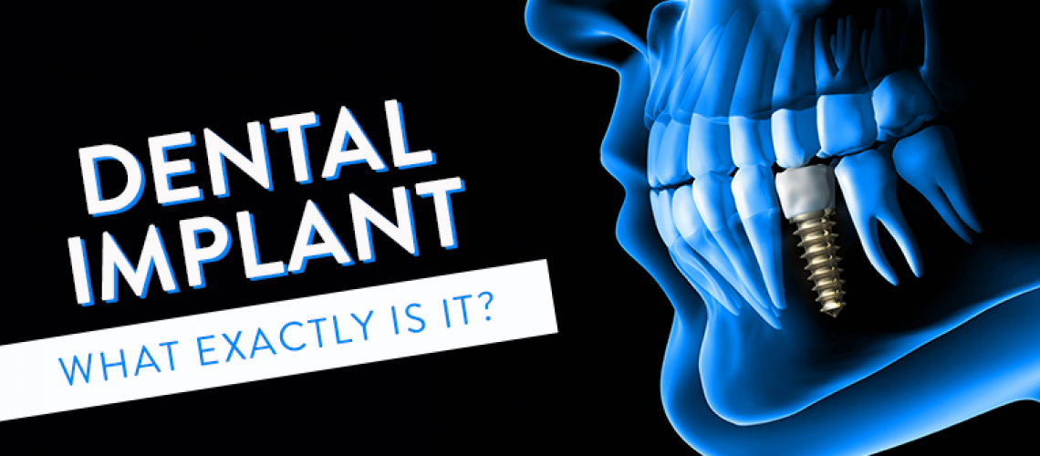 What-Exactly-is-a-Dental-Implant