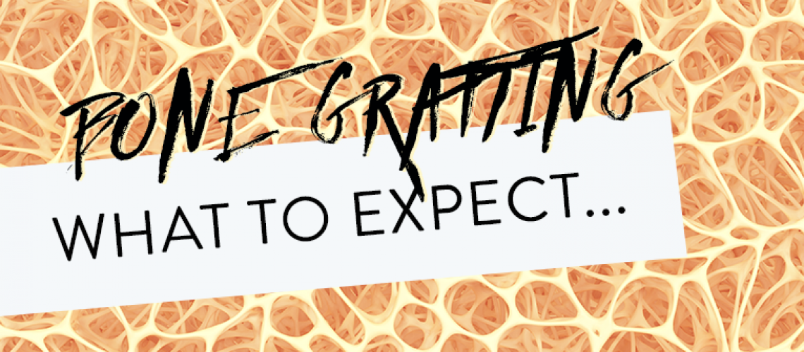 What-to-Expect-When-Expecting-A-Bone-Graft