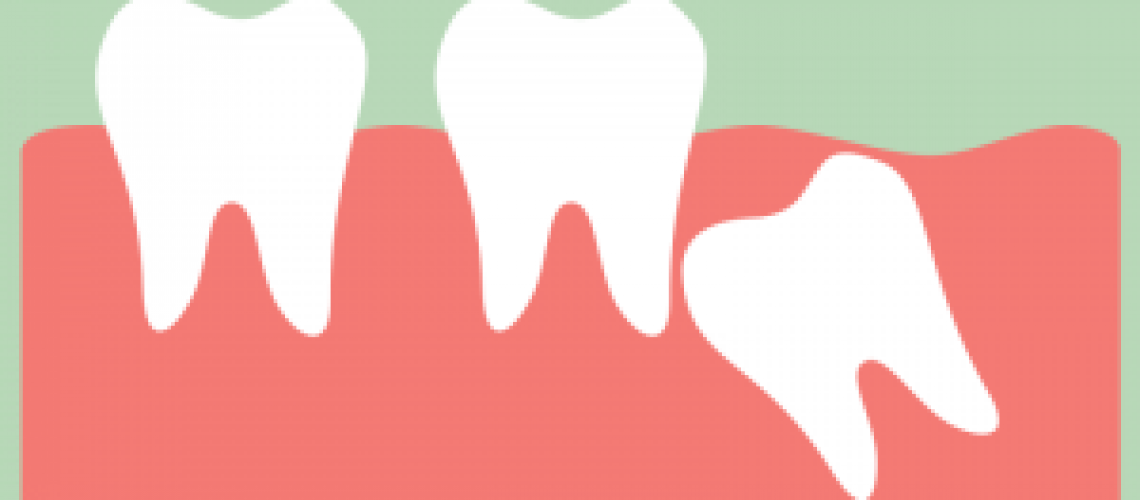 what-is-a-wisdom-tooth-300x150